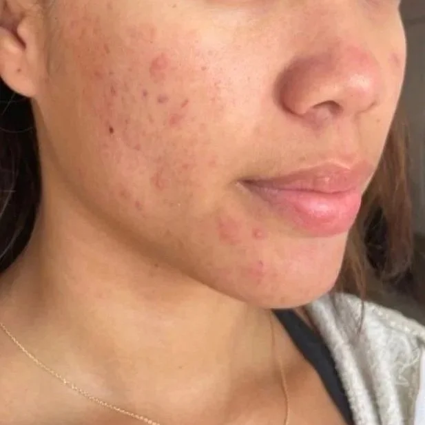 Close-up of a woman's face showing moderate acne with red pimples and inflammation on her cheek and chin.