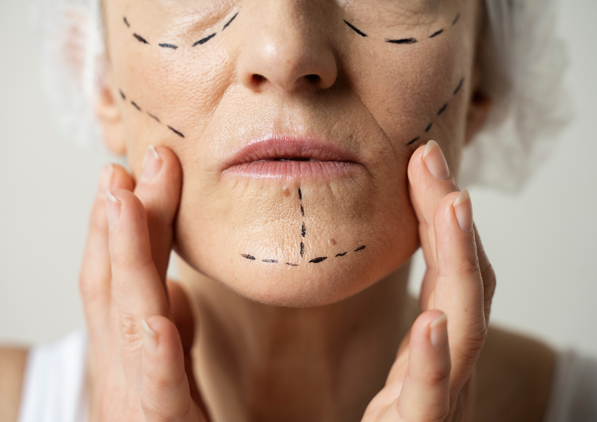 3 Reasons to Consider Thread Lift Now | PHI Clinic