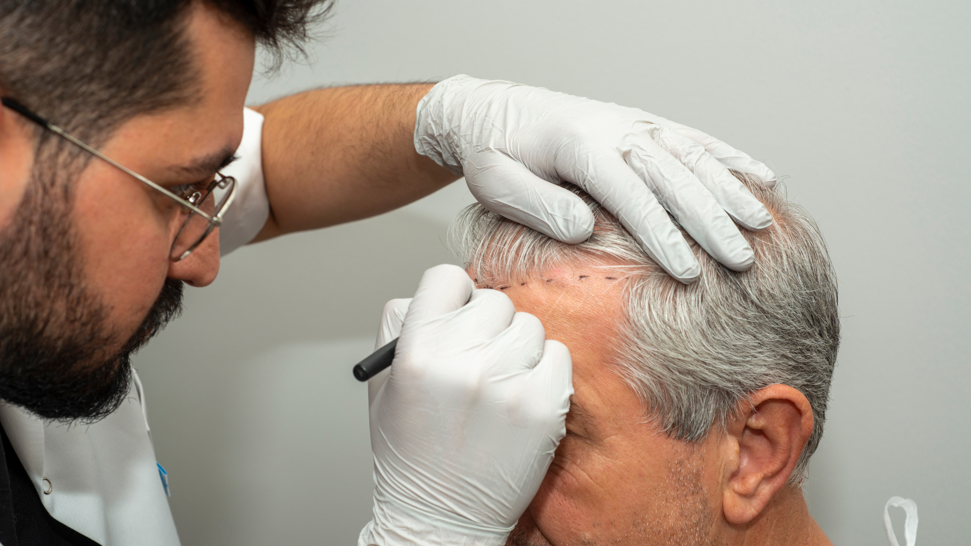 FUE Hair Transplant (Follicular Unit Extraction)