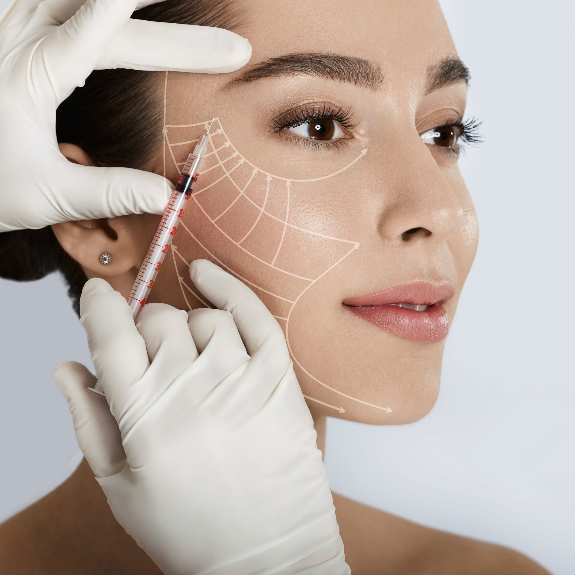 A woman receiving a cosmetic facial procedure, with markings on her face and a syringe held near her cheek by hand wearing white gloves.