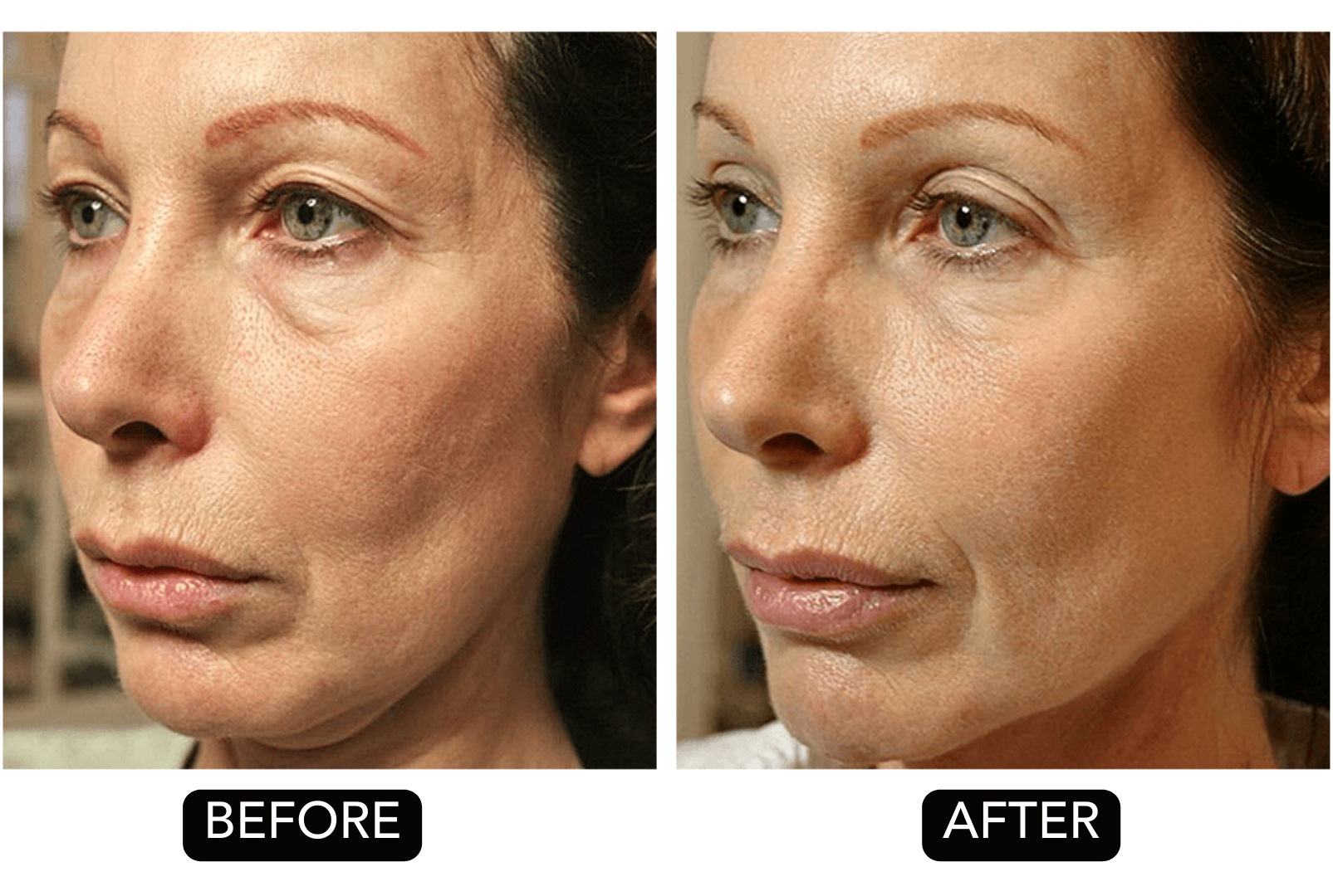 Side-by-side comparison of a woman's face, with visible improvements in skin texture and wrinkle reduction in the "after" photo.