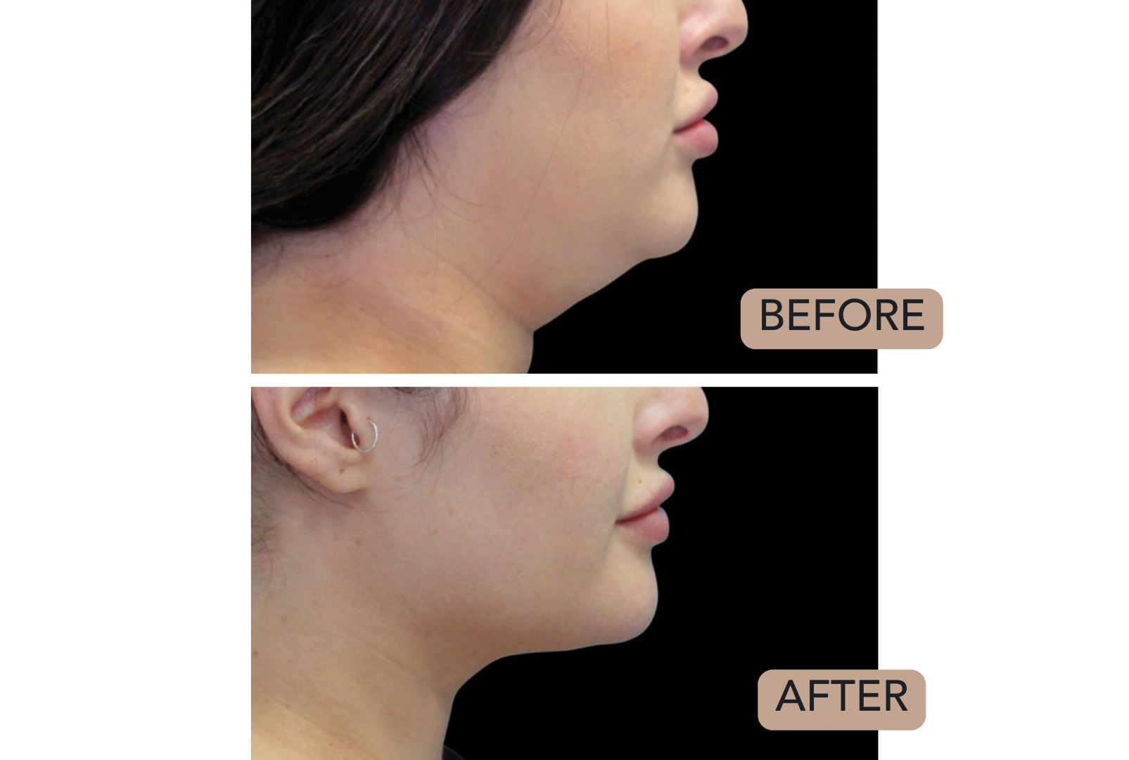 Side-by-side comparison of a woman's profile before and after a cosmetic procedure, showing reduced double chin and improved jawline definition.
