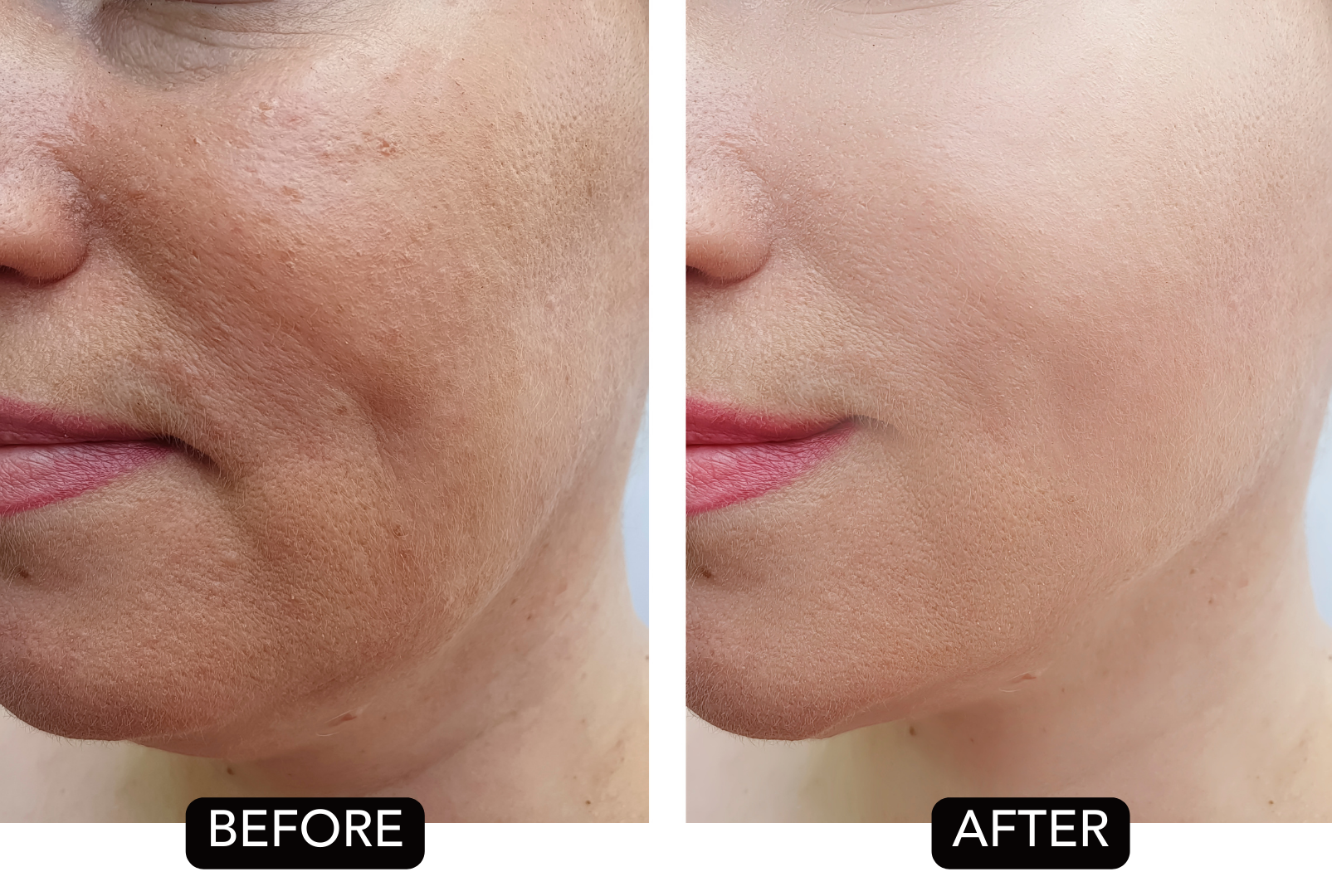 Close-up comparison of a person's cheek before and after skincare treatment, showing improved skin texture and reduced blemishes in the after image.