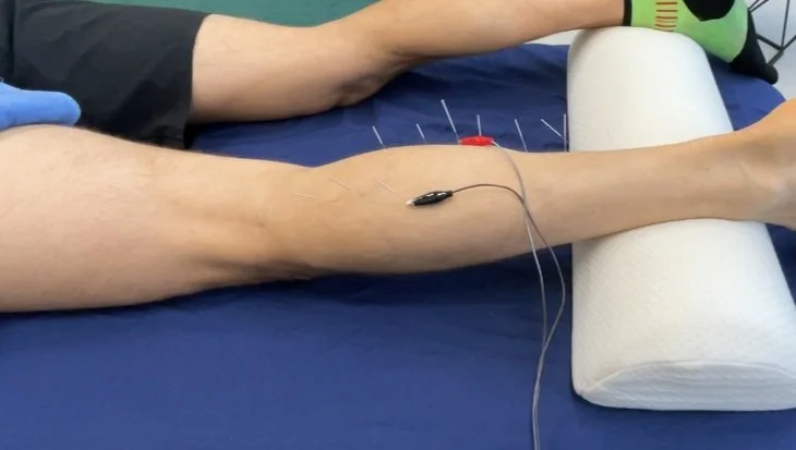 Dry Needling Buzzzzz