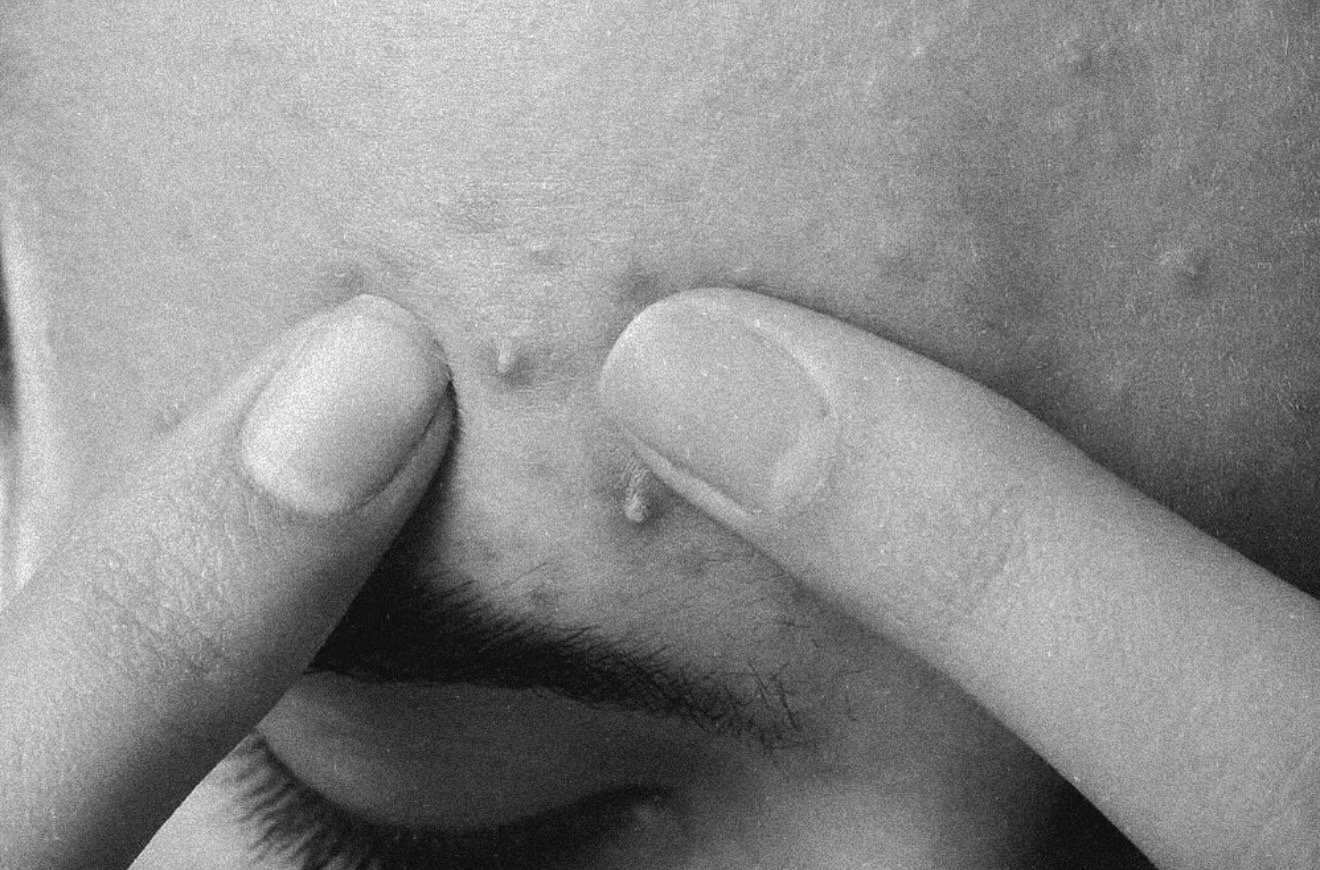 Acne, Congestion &amp; the Fastest Way to Calm It