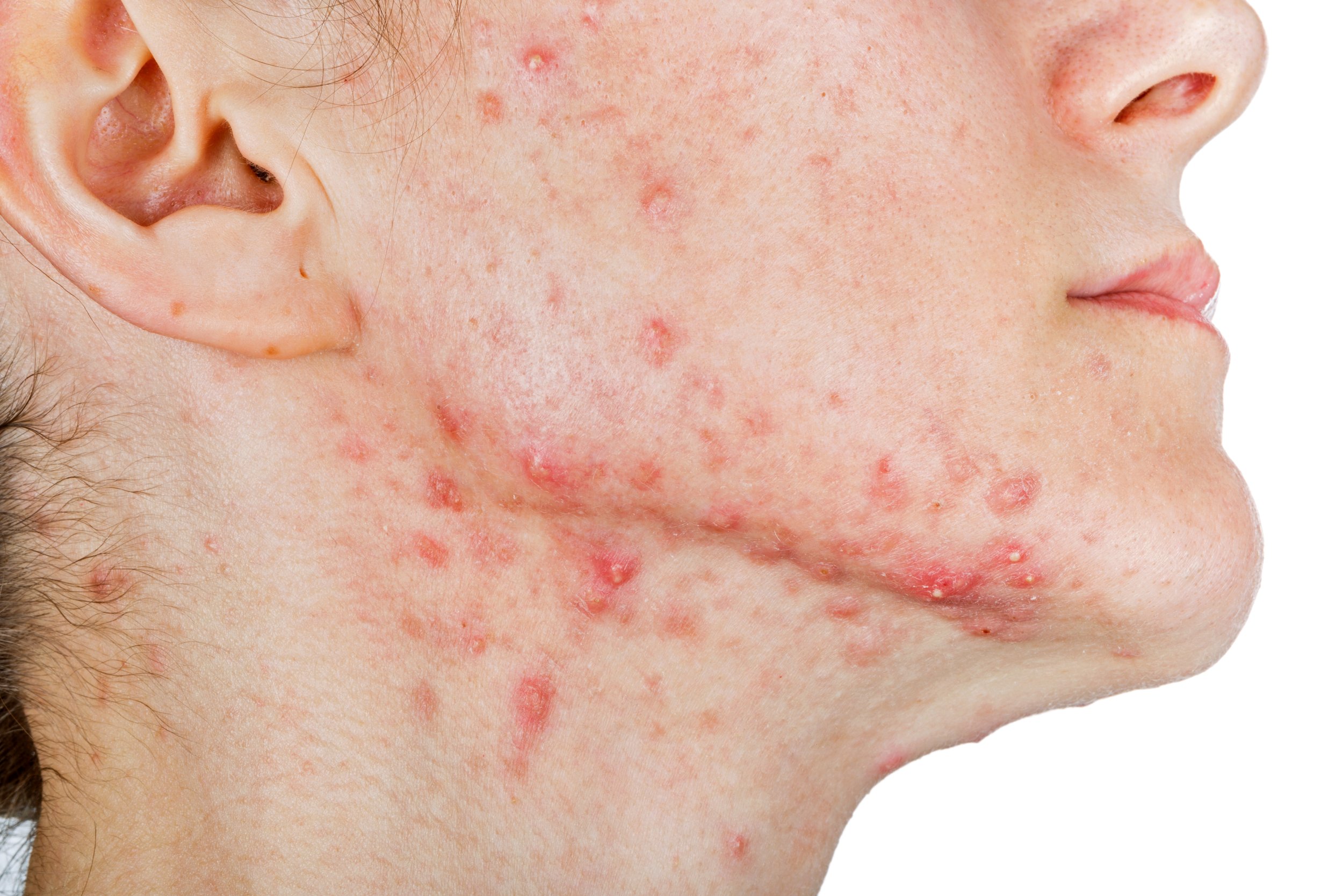 Hormonal Acne: Why It Happens..