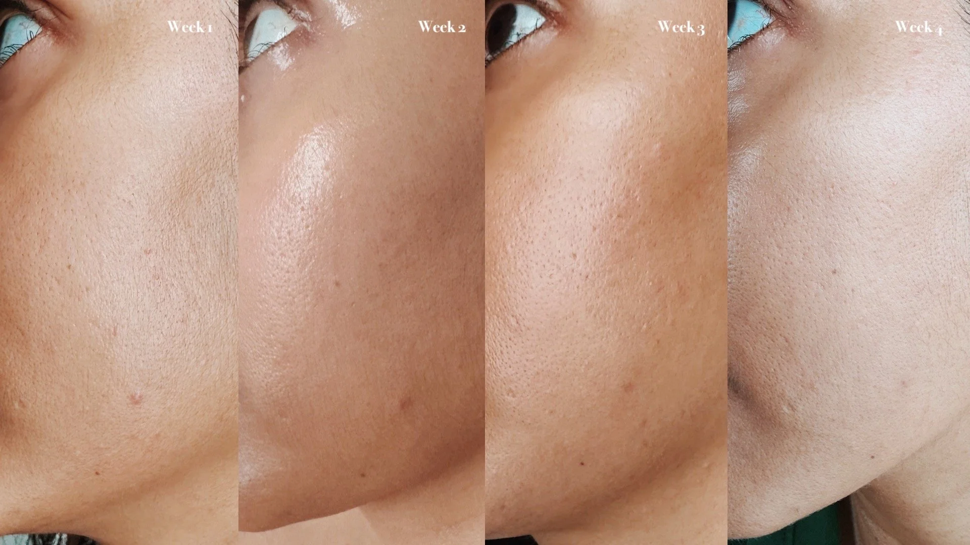 4 week thiamidol results