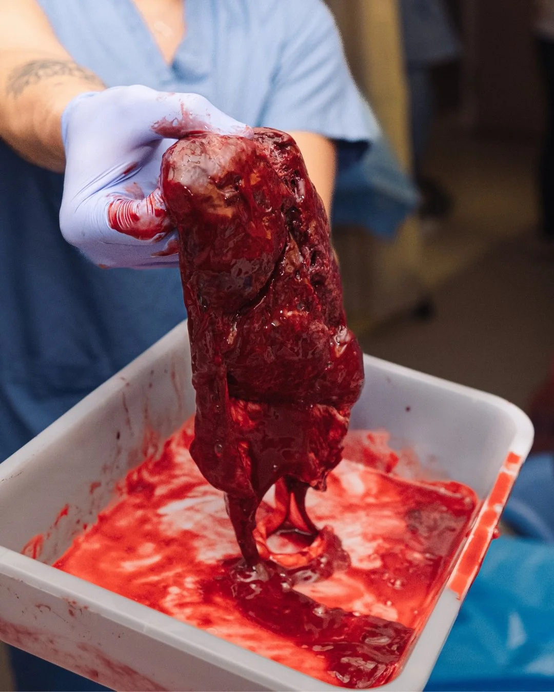 What Your Doctor or Midwife Is Looking For When They Inspect Your Placenta

After birth, your doctor or midwife will inspect the placenta to ensure everything went as expected. This is a critical part of the postpartum process, as the placenta plays 