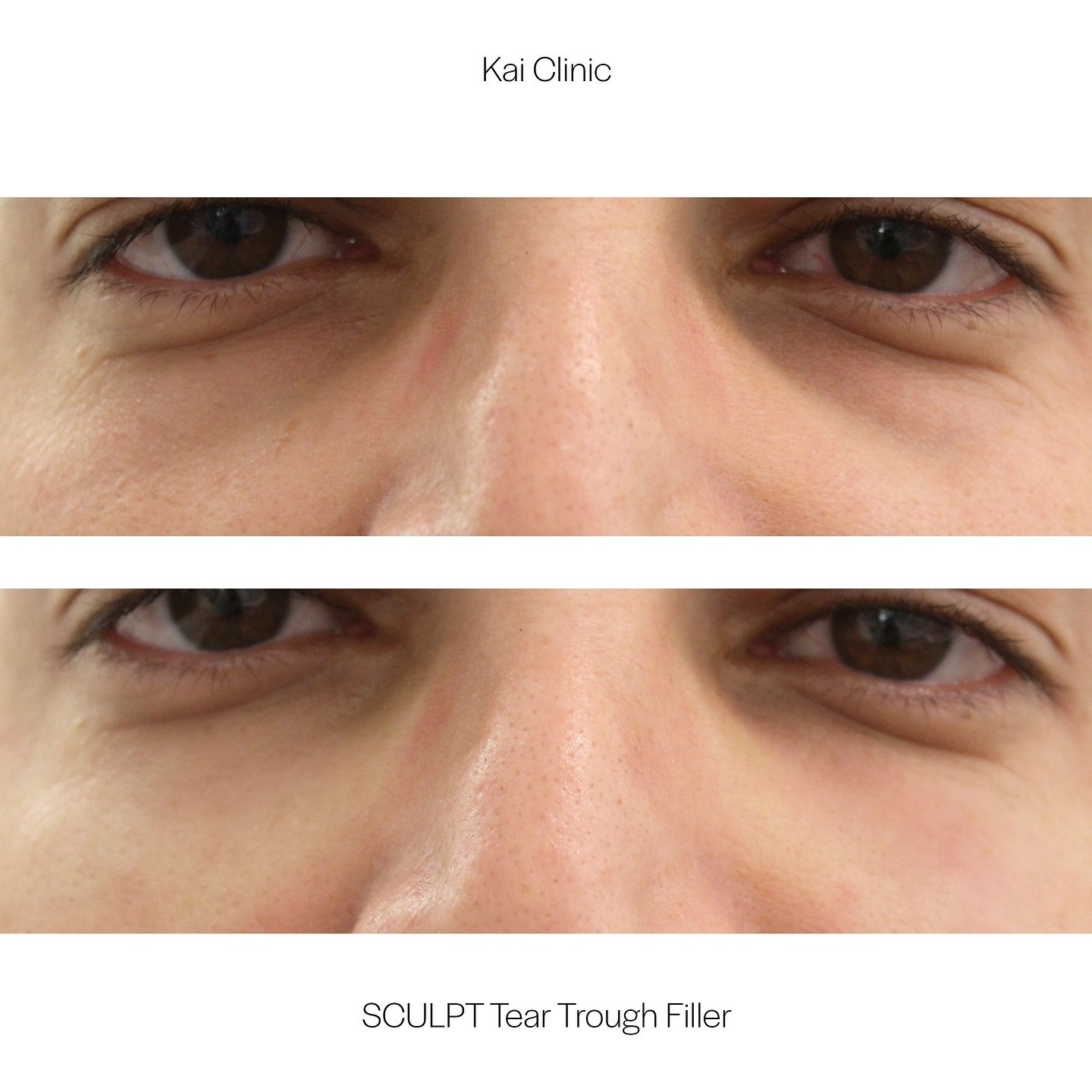 Natural But Noticeable, Brightened &amp; Filled Under Eyes | Book your Kai Clinic Premium SCULPT Tear Trough Treatment Today! 

Browse SCULPT Treatments:
WEBSITE: www.clinickai.com/SCULPT

Book your SCULPT Treatment:
CONSULTATION FORM: www.clinickai.