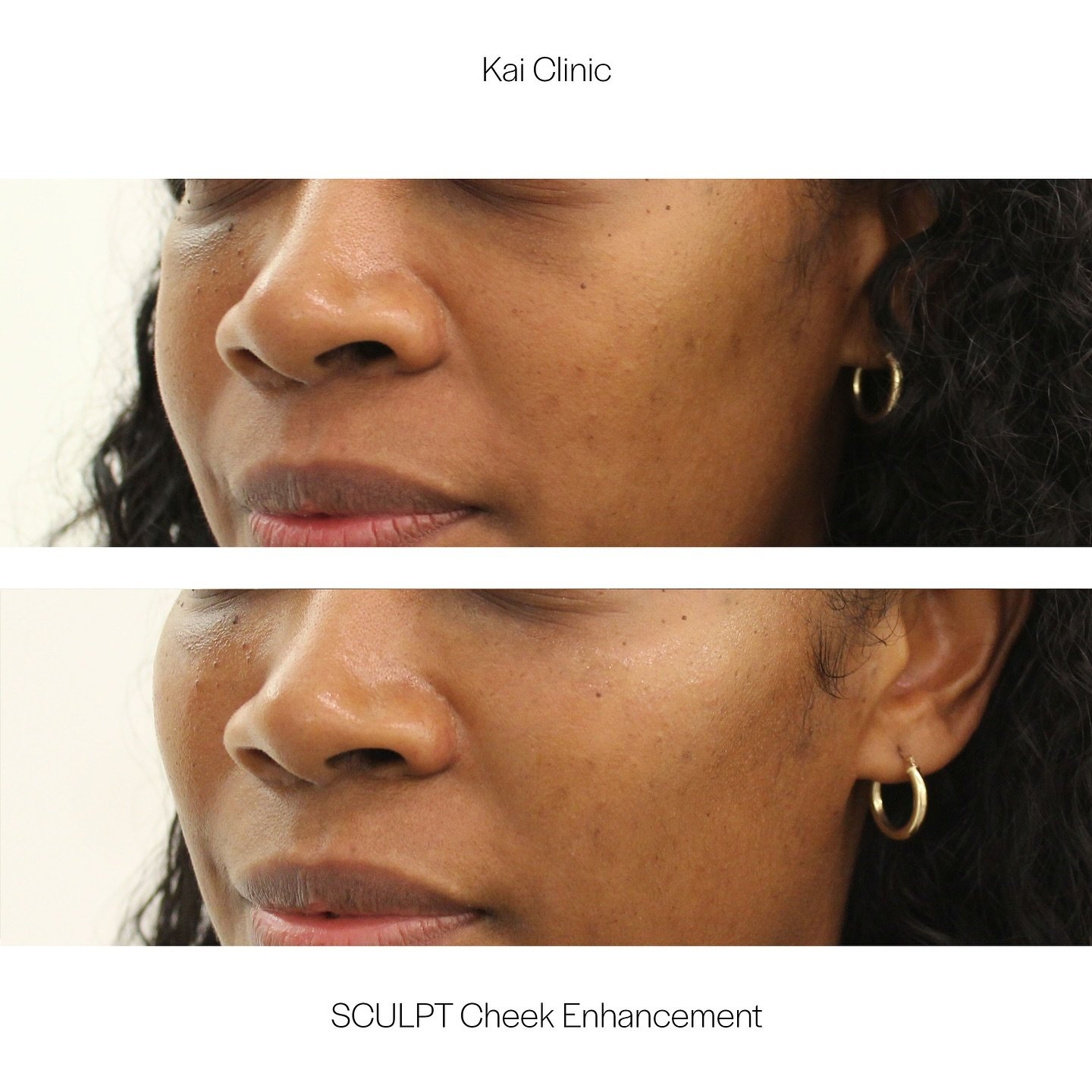 Cheek Volume, Symmetry &amp; Definition - to lift and brighten tired under eyes | Book your Kai Clinic Premium SCULPT Cheek Enhancement Treatment Today! 

Browse SCULPT Treatments:
WEBSITE: www.clinickai.com/SCULPT

Book your SCULPT Treatment:
CONSUL