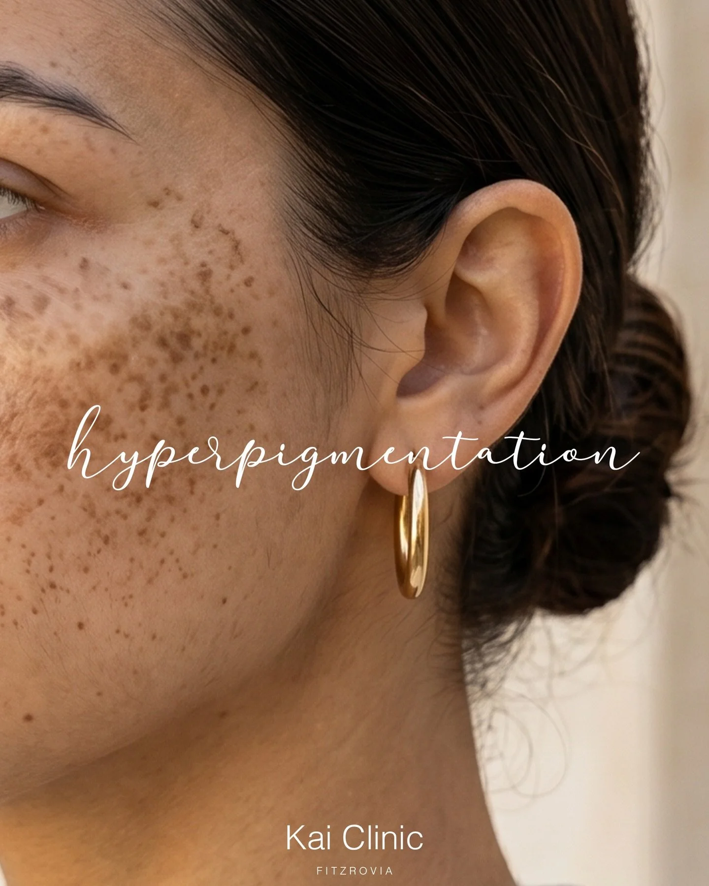 Schedule your hyperpigmentation appointment today at Kai Clinic.