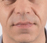 nasolabial-fold-filler-3.png