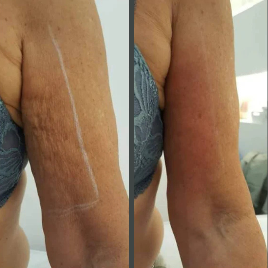 RF Skin Tightening on Arms, Before & After multiple sessions