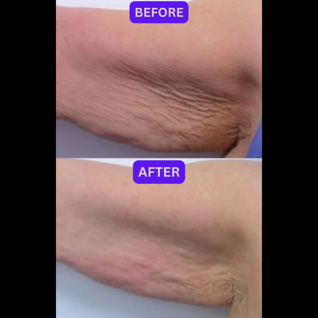 RF Skin Tightening on Arms, Before & After multiple sessions