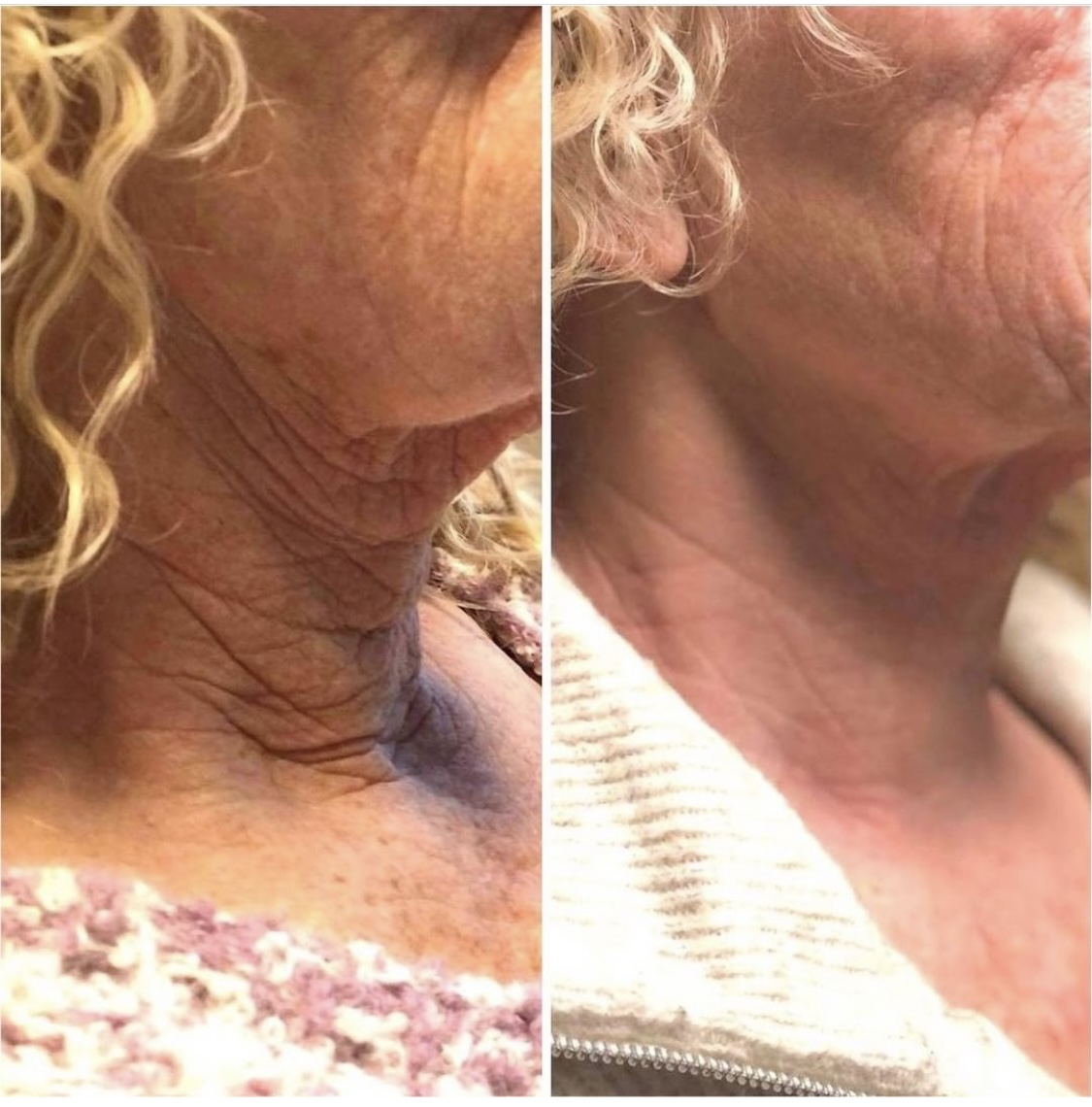 RF Skin Tightening on Neck, Before & After multiple sessions