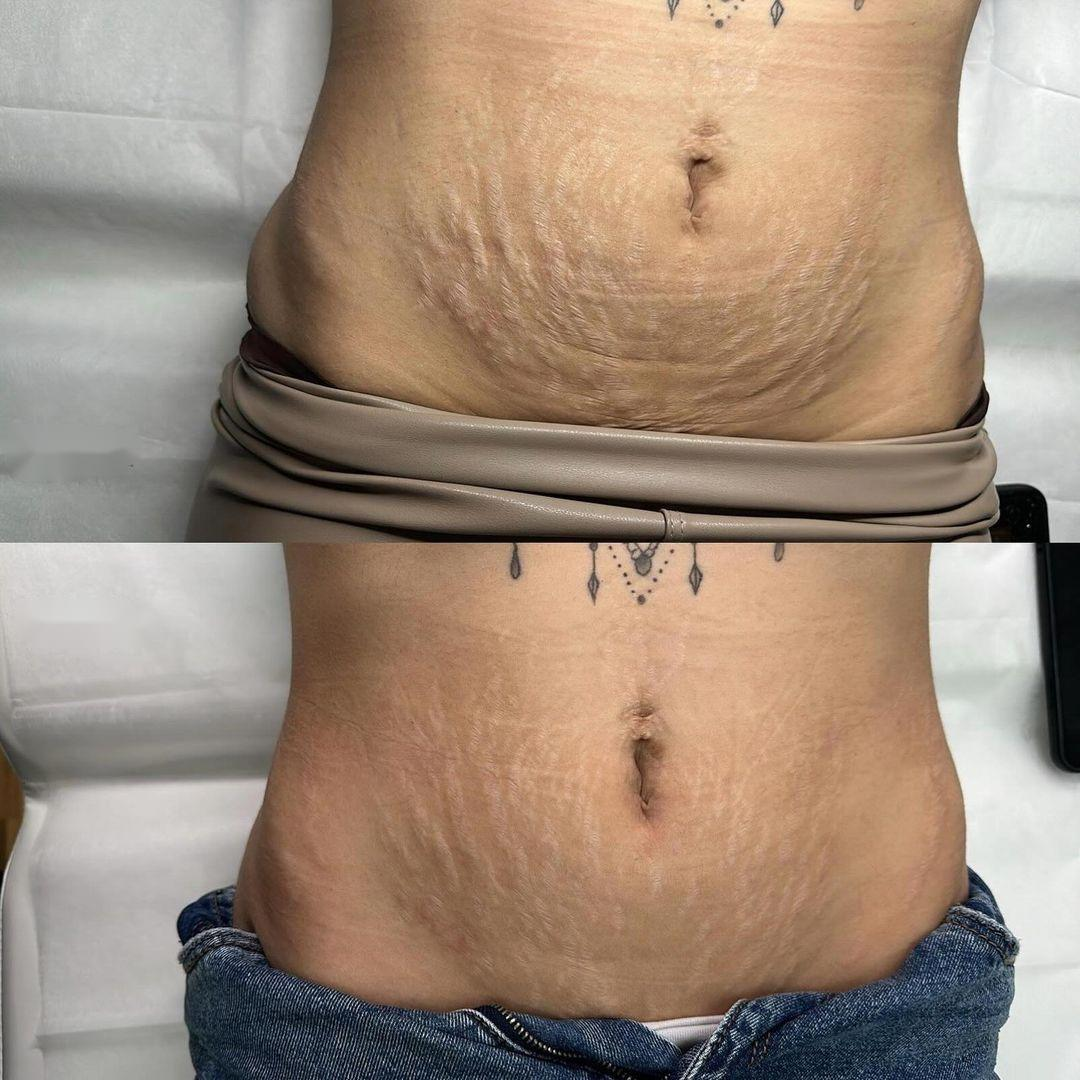 RF Skin Tightening on Stomach, Before & After multiple sessions