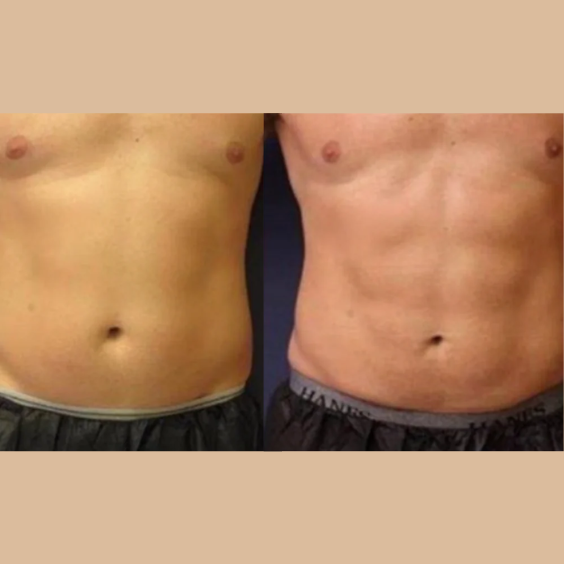 EMS Sculpt on Abs, after multiple sessions