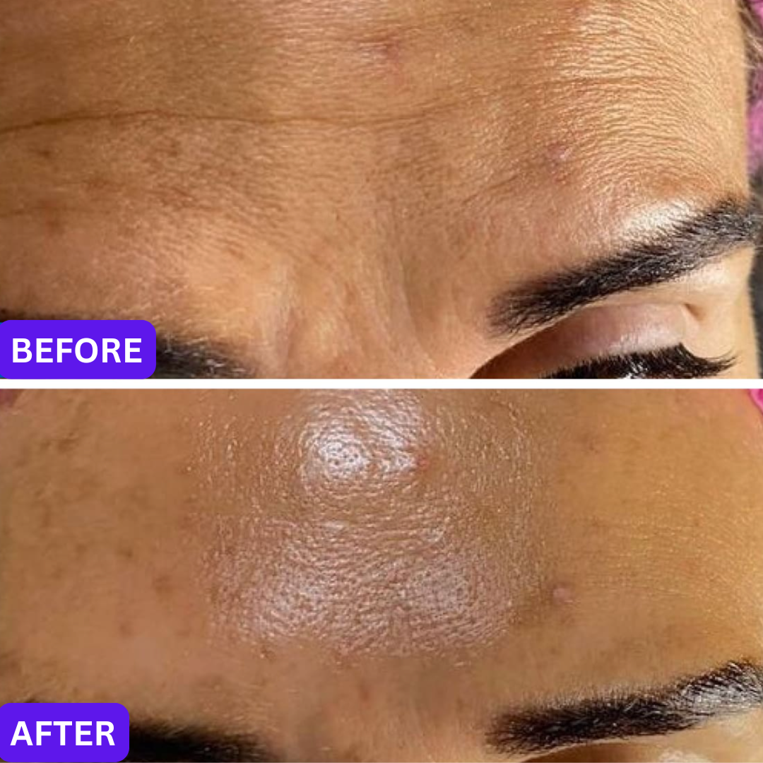 RF Skin Tightening on Forehead, Before & After multiple sessions