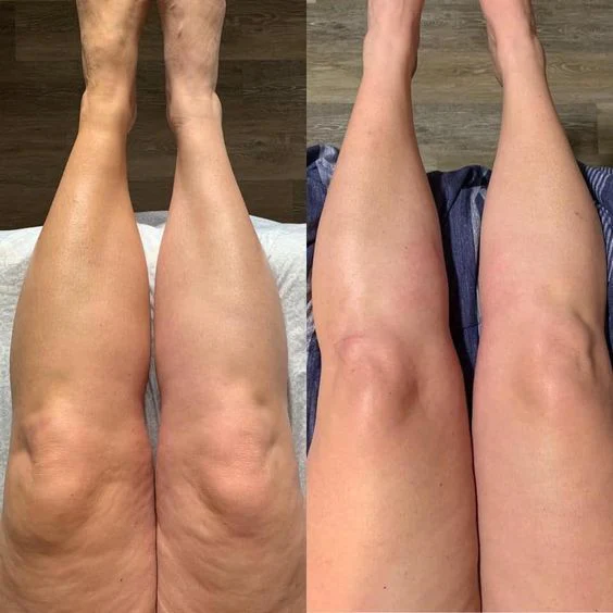 EMS Sculpt on Legs, Before & After multiple sessions
