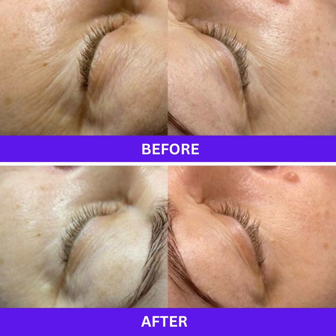 RF Skin Tightening on Crows-Feet, Before & After multiple sessions