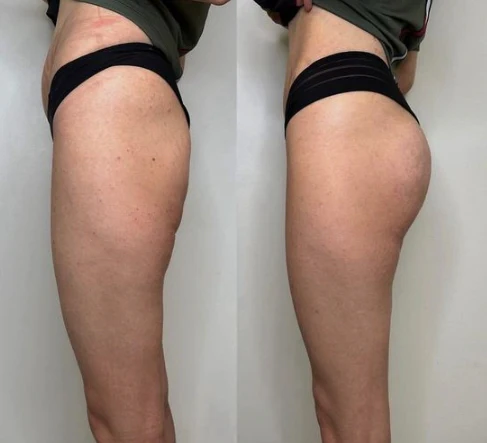 EMS Sculpt on Legs & Glutes & Stomach for multiple sessions