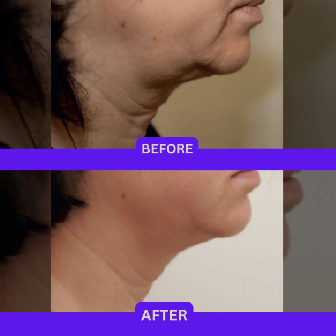 RF Skin Tightening on Neck, Before & After multiple sessions