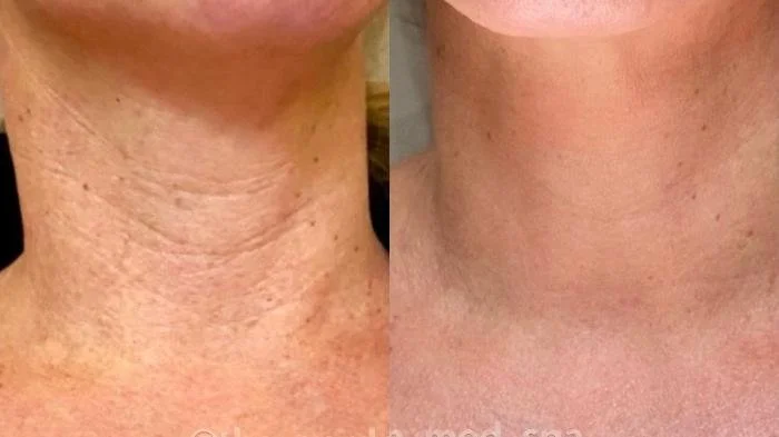RF Skin Tightening on Neck, Before & After multiple sessions