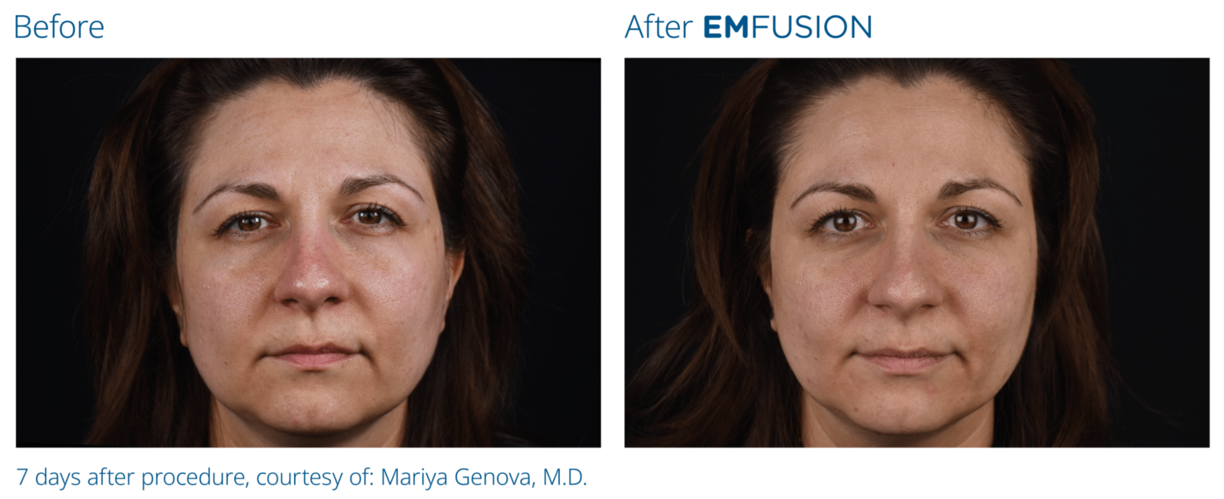 Emeford Injection Emfusion Facial | Harley Street Injectables