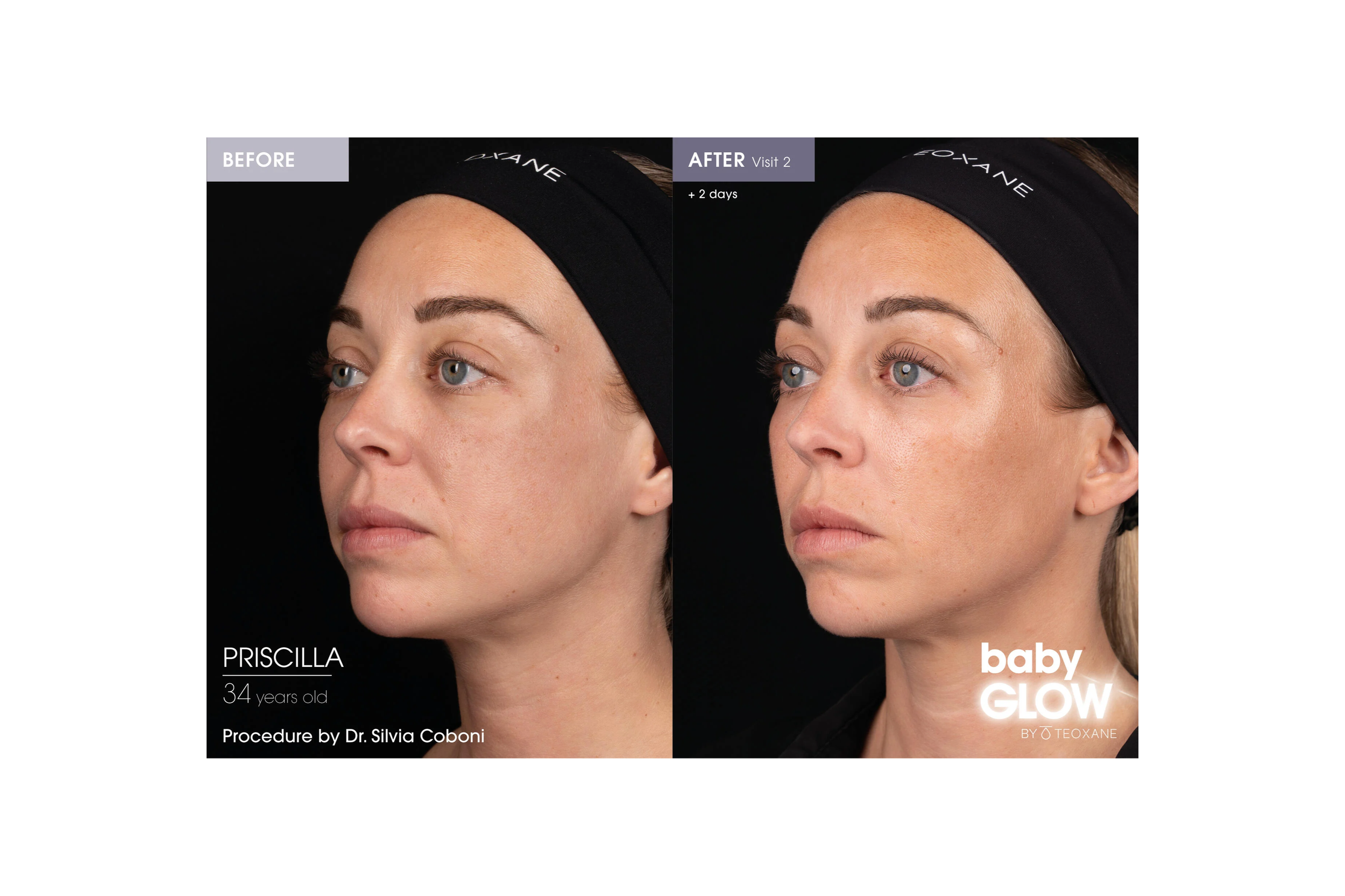 Before and after Teoxane babyGLOW treatment showing improved mid-face skin quality and radiance