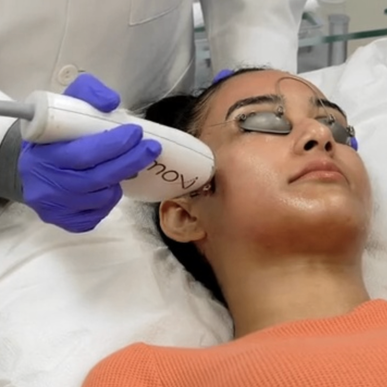 Clear Skin Strategies: Layering AviClear, BBL, MOXI and SkinPen for Acne Scarring