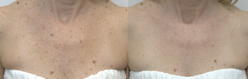 Comparison photo of a woman's chest showing before and after skin treatment, with improved skin appearance in the after image.