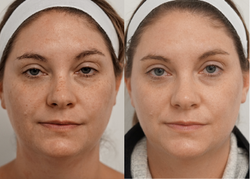 Comparison of a woman's face before and after skincare treatment, showing reduced freckles and clearer skin in the after image.