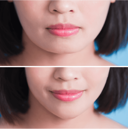Bruxism/Jaw Slimming