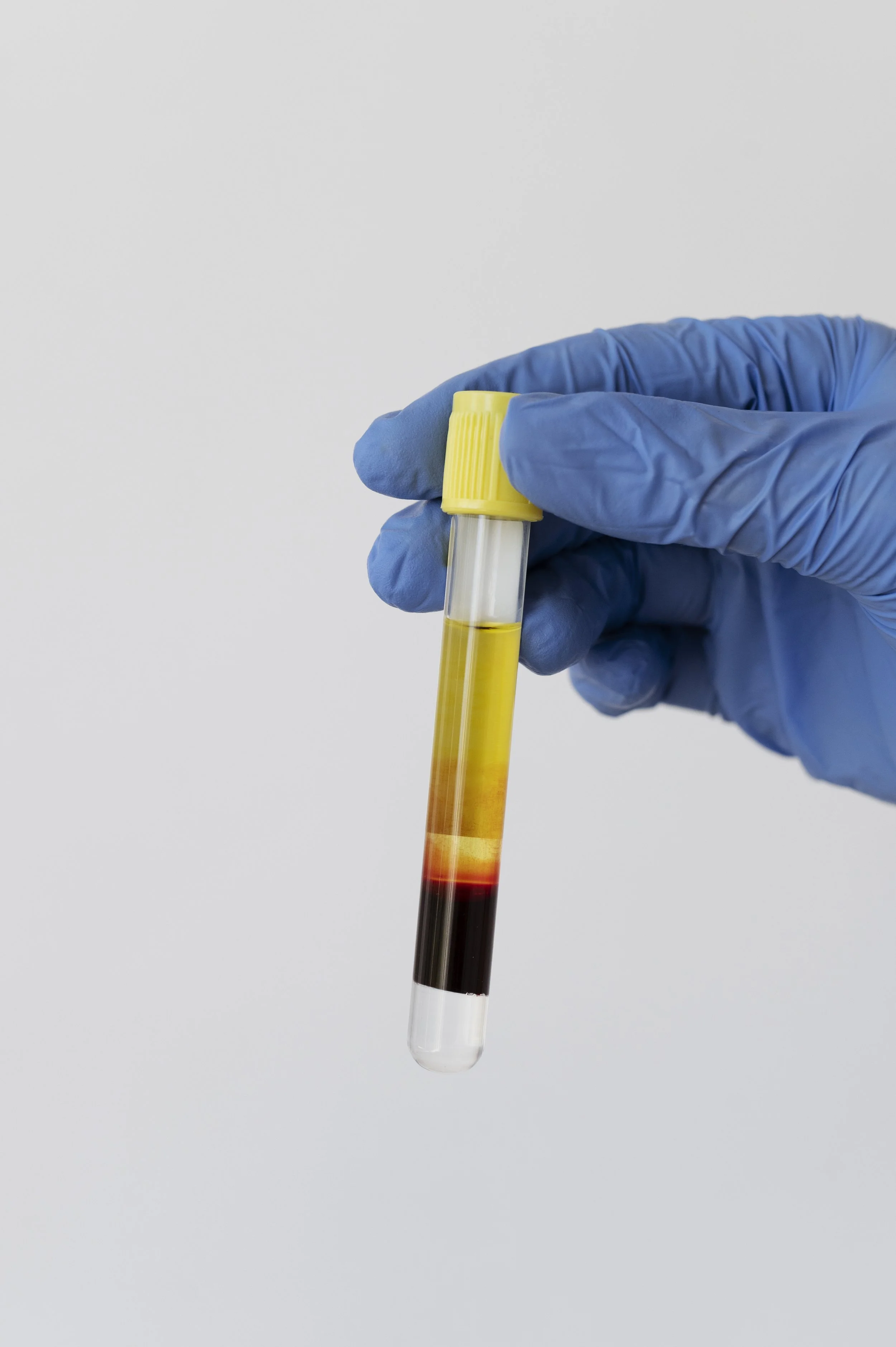 Separated plasma prepared for ezGEL bio filler treatment at Harley Street Injectables