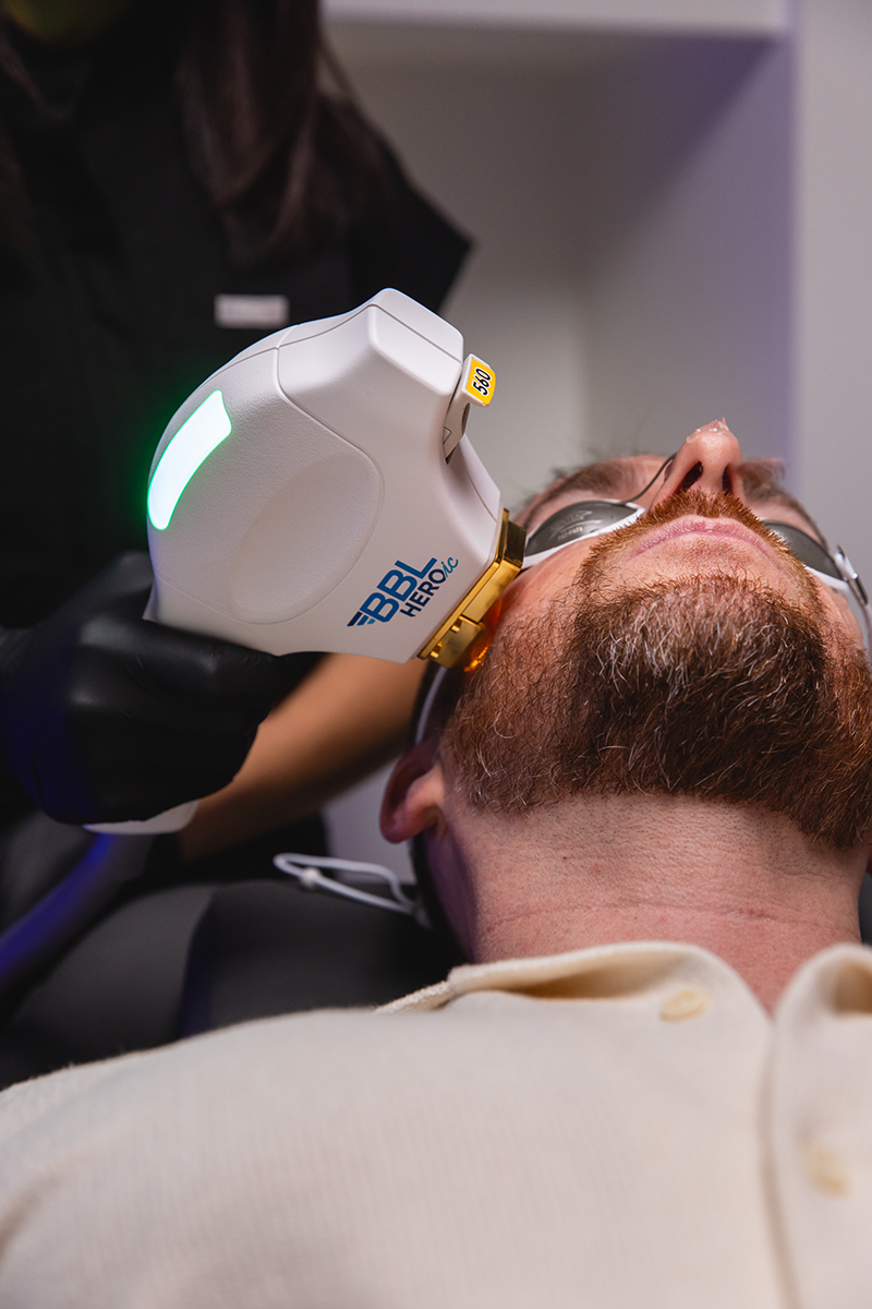 A man is lying down on a medical or cosmetic treatment table, wearing protective glasses, while a technician uses a BBL Hero laser device on his face. The technician is wearing black gloves and a black uniform.