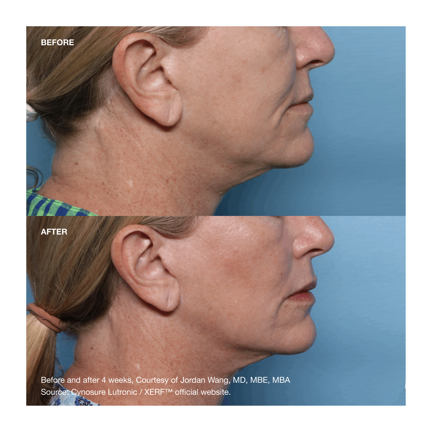 Before and after XERF treatment at four weeks, showing improved jawline definition and neck firmness in profile