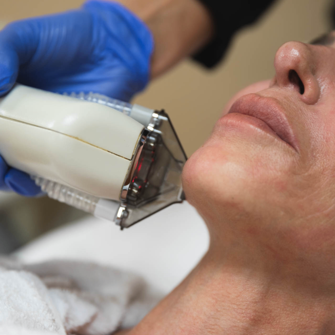 moxi laser treatment