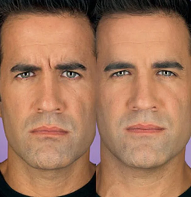 Botox for Upper Face
