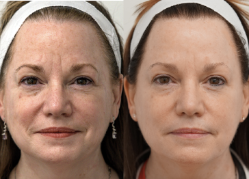 Side-by-side comparison of a woman before and after skincare treatment, showing reduced wrinkles and even skin tone.