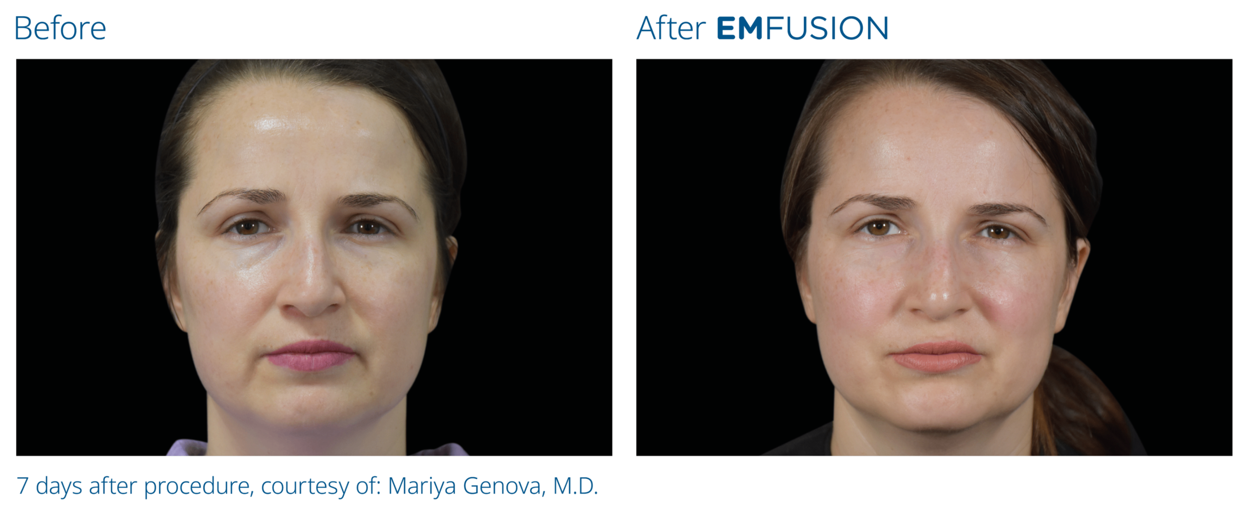 Emfusion Facial | Harley Street Injectables