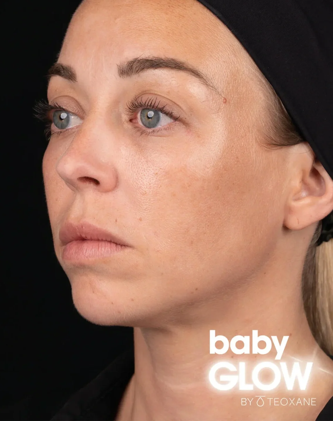 Teoxane babyGLOW
