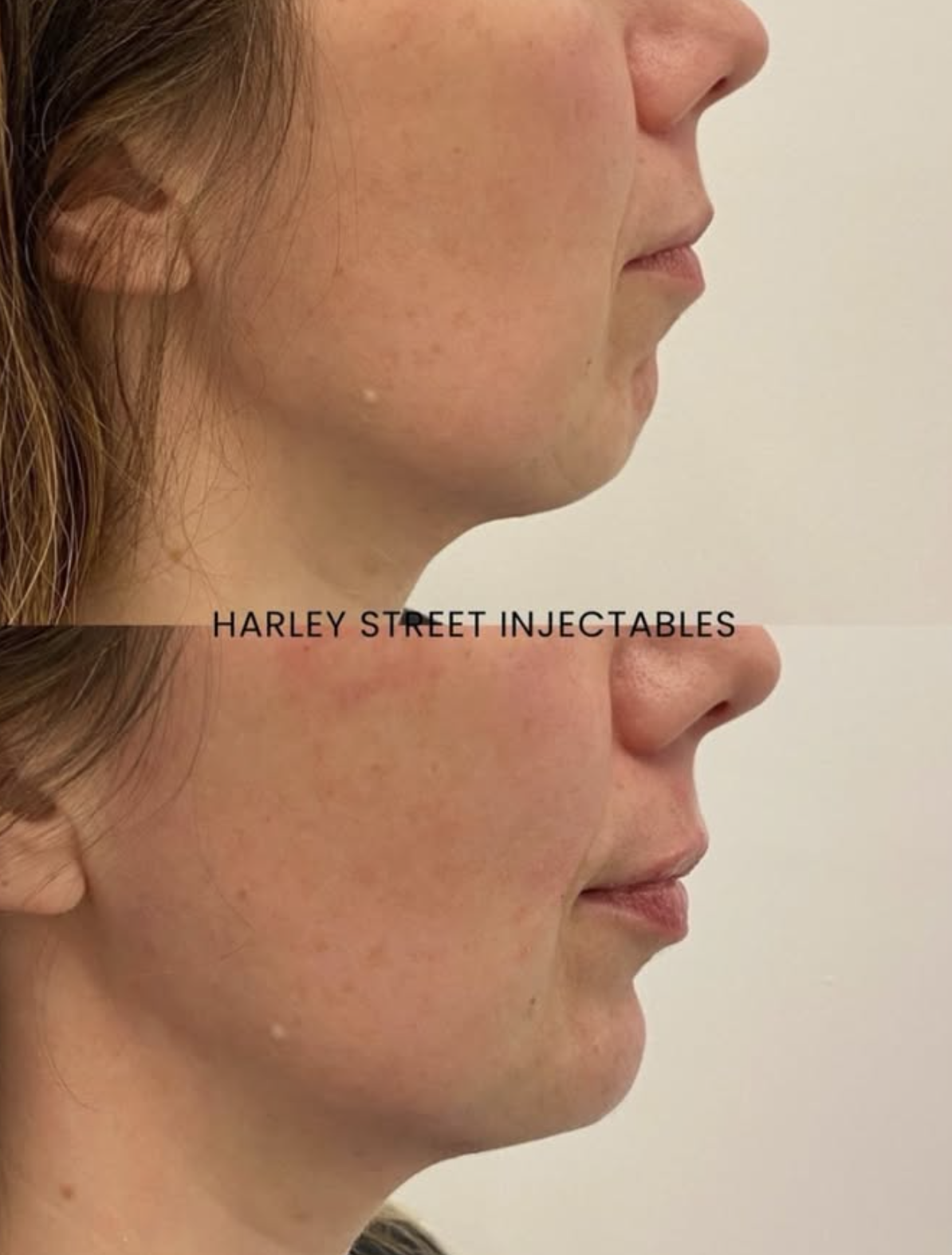 Before-and-after side-profile comparison showing chin filler treatment results at Harley Street Injectables.