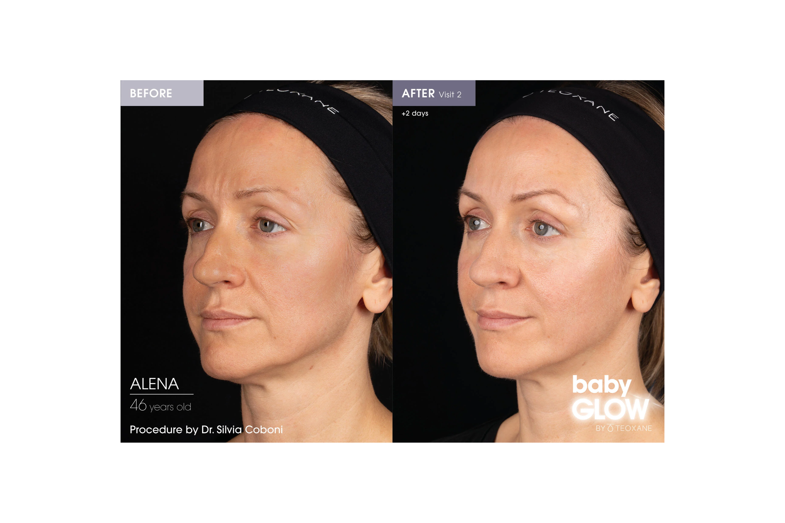 Before and after Teoxane babyGLOW treatment showing smoother, more hydrated skin across the cheeks and mid-face