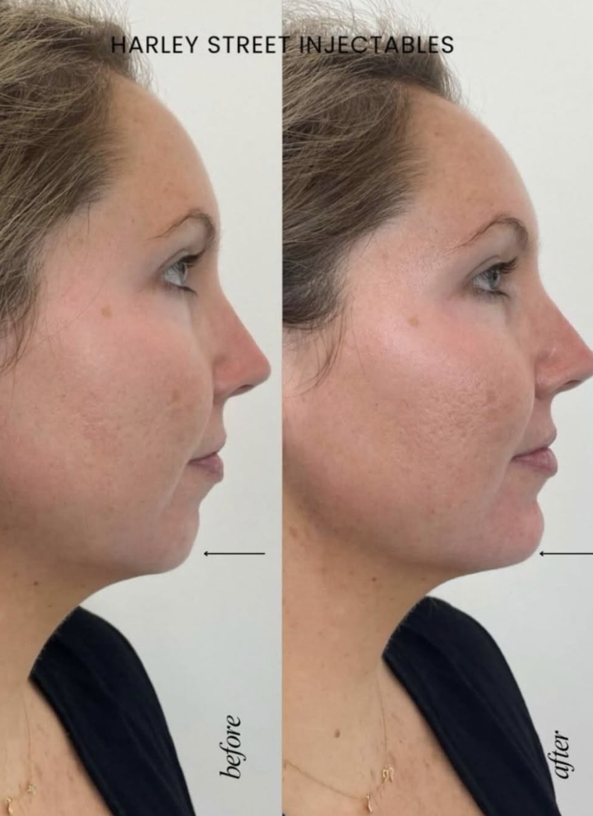 Before-and-after side-profile photos showing enhanced chin projection following chin filler treatment at Harley Street Injectables.