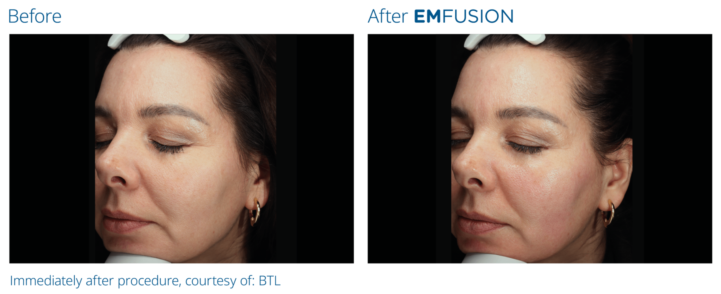 Emeford Injection Emfusion Facial | Harley Street Injectables