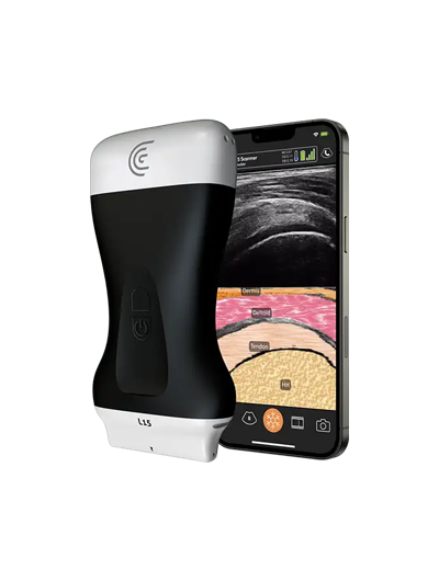 A smartphone displaying an ultrasound image and a handheld ultrasound device.