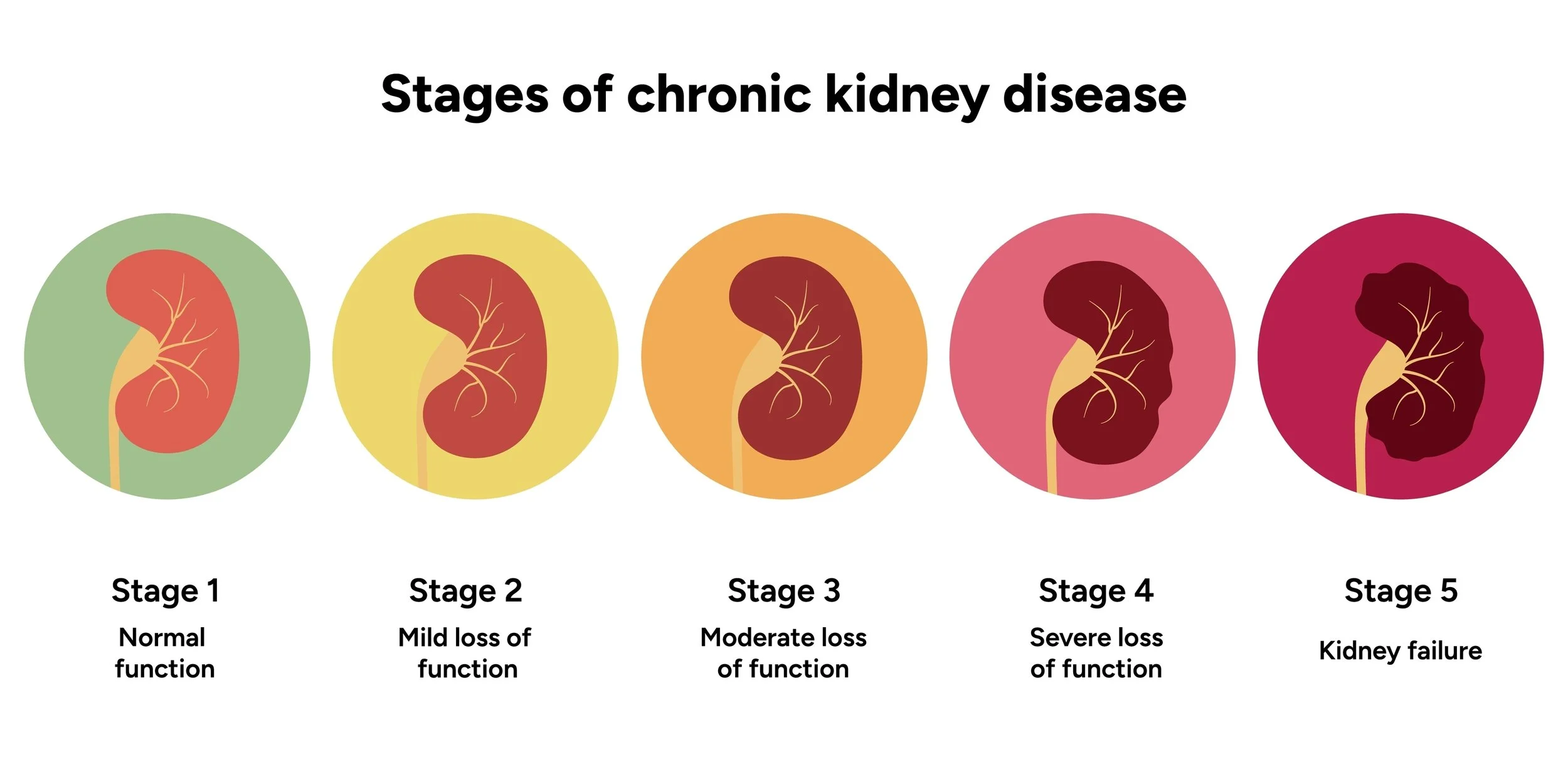 a chart showing the 5 stages of chronic kidney disease from normal to kidney failure