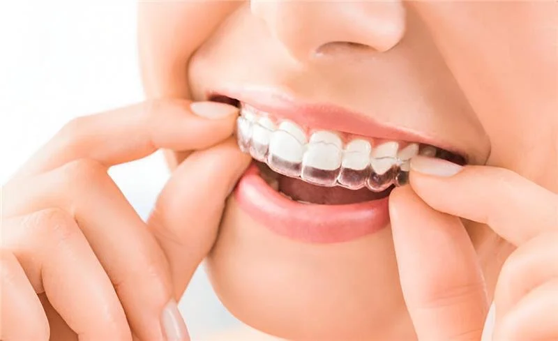 Invisalign Clear Braces vs. Traditional Braces: Which Is Right for You?