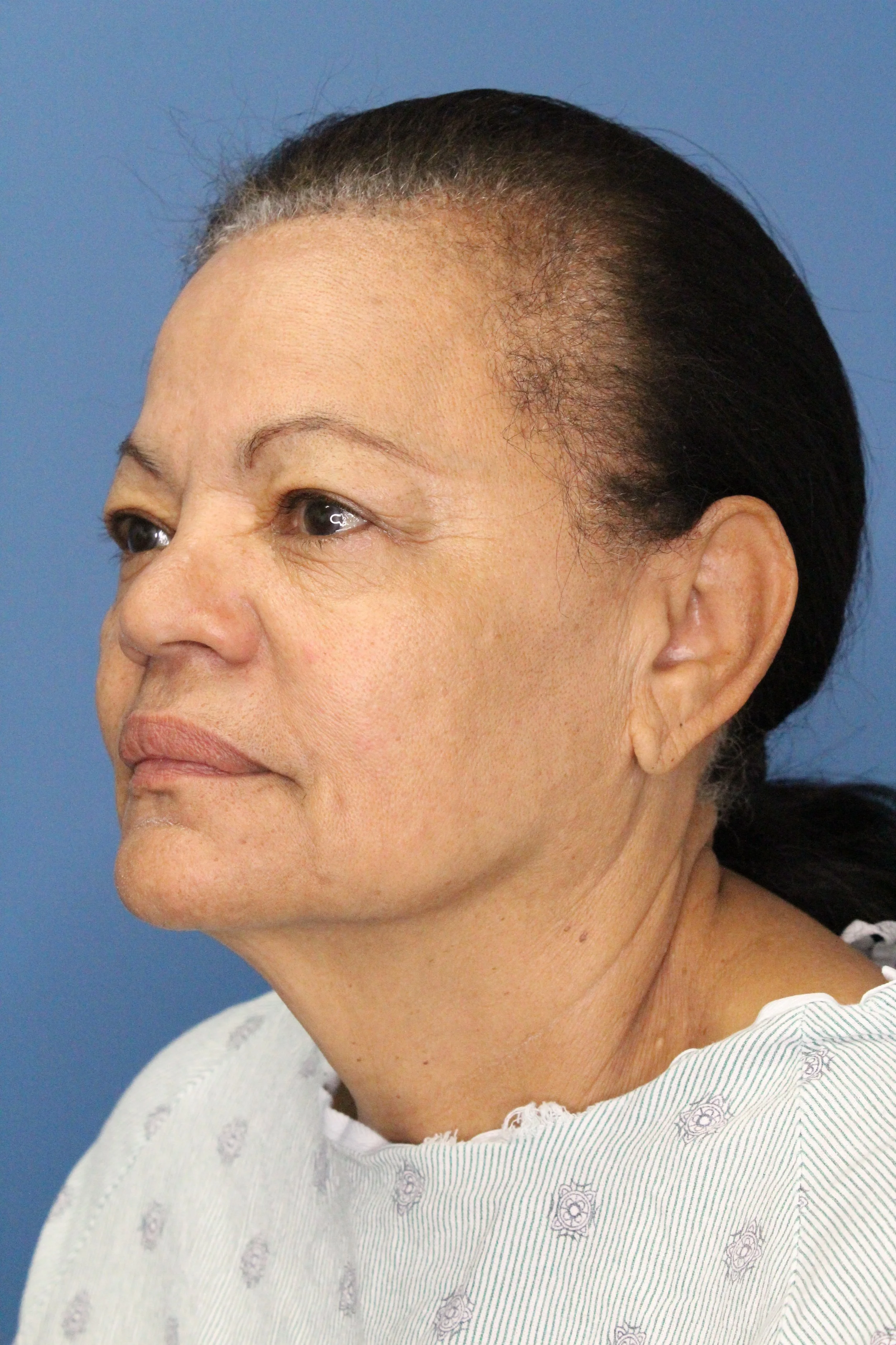 Deep Plane Face and Neck Lift