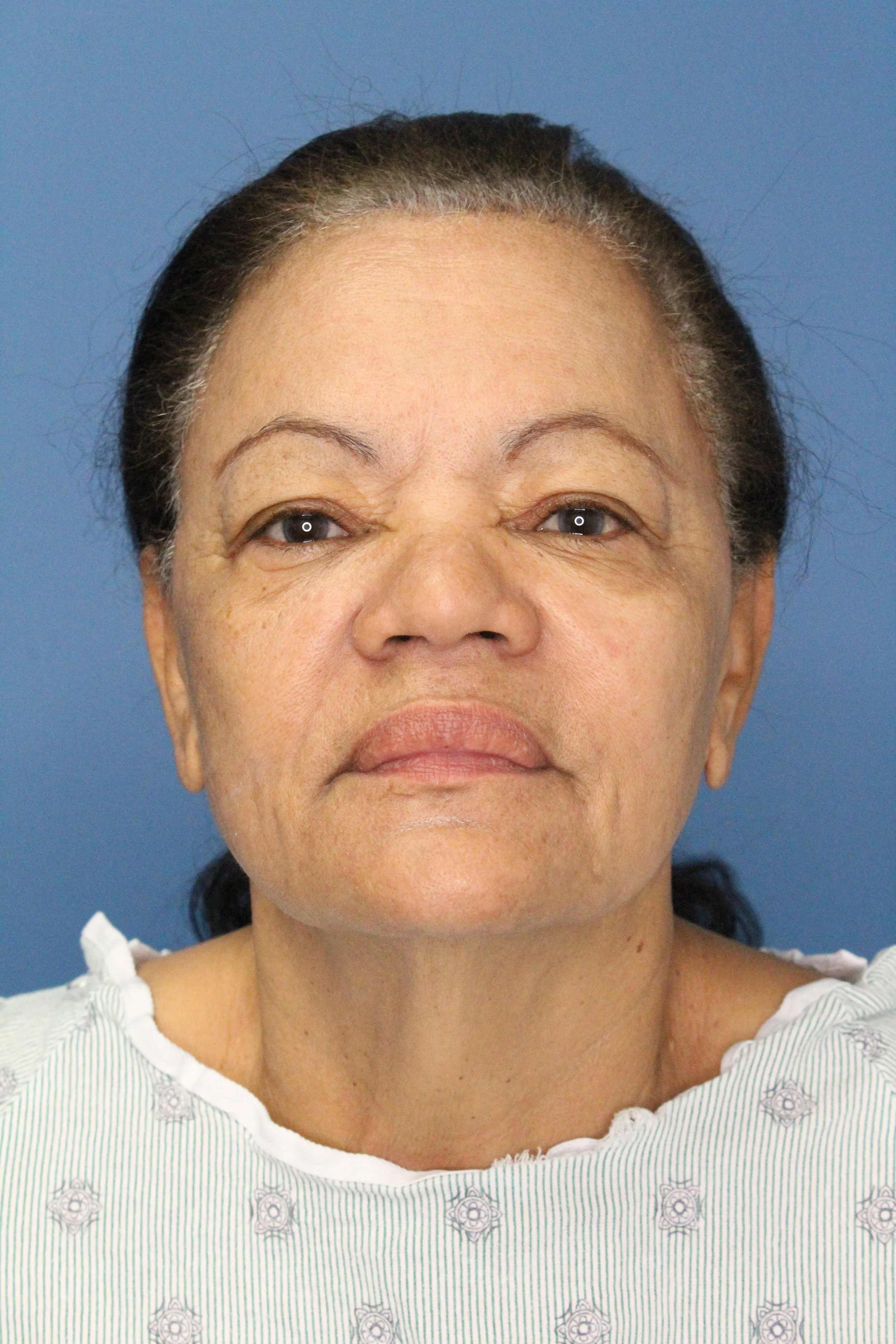 Deep Plane Face and Neck Lift